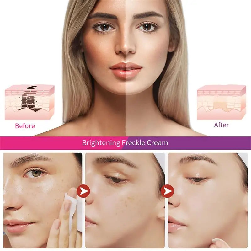Whitening Spot Removing Cream Nicotinamide Effectively Lightening Dark Spot Acne Marks Remove Melasma Face Skin Care Cosmetics